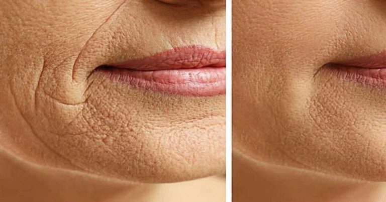 Krema Beauty Derm protiv bora